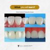 Masterclass: Direct Anterior Veneer and Posterior Restoration - Image 2