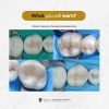 Masterclass: Direct Anterior Veneer and Posterior Restoration - Image 3
